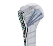 VOLT Proximal Humerus Plating System