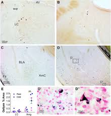 Chronic Sleep Disruption Advances the Temporal Progression of Tauopathy in  P301S Mutant Mice