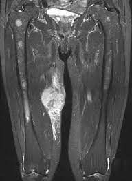 Das gesamte gewebe des befallenen tumorbereichs (z. Knochen Und Weichteiltumore Ursachen Diagnose Therapien Orthinform