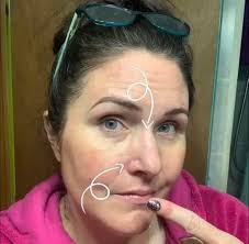 So I've been getting bad acne