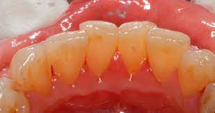 Dersom en slik blemme dukker opp alene kan den være et symptom på en kronisk betennelse omkring en tannrot. Tannkjottbetennelse Gingivitt Felleskatalogen