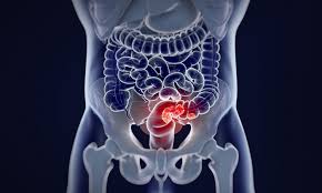 Rectal cancers (sometimes termed colorectal cancers) are composed of abnormal, uncontrolled cells that may metastasize (spread) to other organ systems. Altering Balance Of Fibroblasts Could Prevent Spread Of Colorectal Cancer