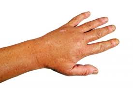 Geschwollene Finger Ursachen Behandlung Vorbeugung Gesundpedia De