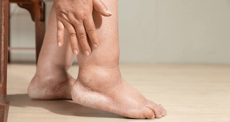 Leg swelling