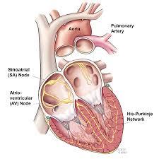 Sometimes there is confusion between the terms cardiac arrest and heart attack. a heart attack, or myocardial infarction, is damage to the heart muscle that occurs. Sudden Cardiac Death Scd Symptoms Causes