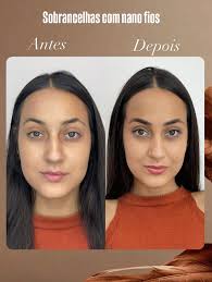 Era o sonho dela se livrar dessas falhas que davam muita diferença no olhar  dela. 🥺🤌🏻 E vejam só….