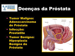 Tratamentul adenomului de prostata este variat in dependenta de fiecare caz aparte. Cancer De Prostata Benigno E Maligno Cancer De Prostata Benigno E Maligno