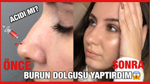 Burun Dolgusu Yaptirdim Burun Dolgusu Nasil Yapilir Youtube