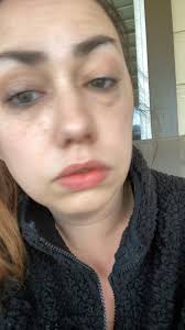 January 2021 I had worked 2 doubles in a row, came home and passed out  while i was cooking but as soon as i woke back up i knew my face was not in  a good way my mouth wouldn’t open and the right side ...