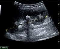 Ultrasonography Of Kidney Stone Disease Radlines Org