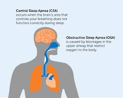 Image result for Sleep Apnea