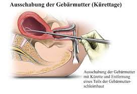 Für links auf dieser seite zahlt der händler ggf. Ausschabung Fehlgeburt Periode Nach Schwanger Ablauf Gebarmutter