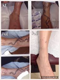 See reviews, photos, directions, phone numbers and more for the best tattoo removal in east los angeles, ca. Renee Patel Md Tattoo Removal Los Angeles Home Facebook