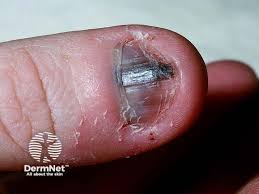 Image result for Acral lentiginous melanoma nail
