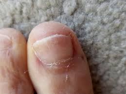 Just as acv can help kill candida in the body, it is often useful against yeast and fungus on the skin and nails. Nail Fungus Treatment Over The Counter Lifestyle Fifty