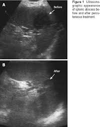 Image result for Splenic Abscess