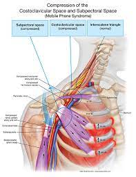 How Sustained Contraction Of Your Shoulder Muscles Can Lead To Neck Pain Shoulder Pain And Thoracic Outlet Syndrome Thoracic Outlet Syndrome