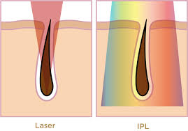 It is important to understand however how areas of skin which have higher pigment, such as freckles and moles, as well as darker skin generally, will also absorb more light energy and heat as a result. Ipl Vs Laser What S The Difference Smoothskin
