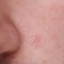Abszess Pickel Standig In Der Gleichen Stelle Gesundheit Und Medizin Gesundheit Haut