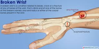 How to tell if your wrist is broken. Broken Wrist Treatment Exercises Causes Symptoms Signs
