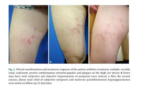 Image result for pruritic urticarial papules and plaques of pregnancy