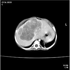 And internationally, and minimizing risk factors seems to be the best preventative measure. Liver Tumors In Infancy Intechopen