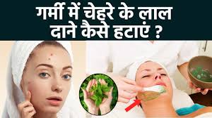 गर्मी में चेहरे के लाल दाने हटाने का तरीका