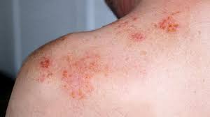 Image result for shingles in children