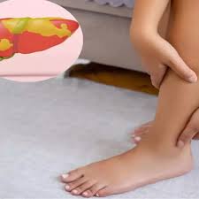 Fat:ty liver disease: The sign in your feet that means the condition is  irreversible