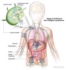 B lymphocytes (b cells) or t lymphocytes (t cells). Childhood Non Hodgkin Lymphoma Treatment Pdq Patient Version National Cancer Institute