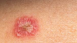 Cara merawat tanaman cabe di usia 0 haring hingga 1 bulan 2. Kurap Gejala Penyebab Diagnosis Penanganan Pencegahan Halodoc Com