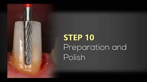 We did not find results for: Dental Post Cementation And Core Build Up With Cosmecore Youtube