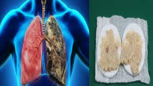 Se amesteca făina și mierea, iar apoi se adaugă ghimbir și ulei de măsline. Ghimbirul Elimina Mucusul Din Plamani Intr O Singura Noapte Si Vindeca Tusea Youtube