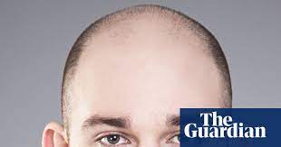 Even though hair loss and thinning are complex, it's relatively simple to narrow down potential causes. Going Going Gone I Started Losing My Hair At 16 Men S Hair The Guardian
