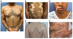 Image result for Vitiligo