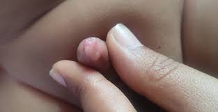 Smegma Pearl: A Benign Penile Lesion in Infants