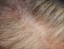 Make things a little easier with these psoriasis of the scalp occurs in 75% to 90% of people with psoriasis, generally in the area behind the ears, says dominic burg, chief scientist. Indian Journal Of Dermatology Venereology And Leprology Psoriatic Alopecia Fact Or Fiction A Clinicohistopathologic Reappraisal