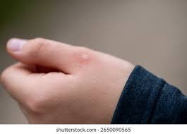 Image result for spinne biss haut reaktion