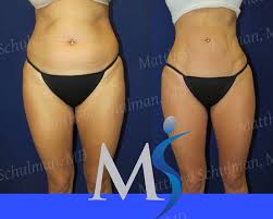Image result for Liposuction