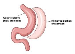 Of the $20,000 cost for uninsured patients, a small. Gastric Sleeve Weight Loss Surgery Cost Weightlosslook