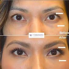 Eye Transformation Upper Eyelid Asymmetry Plastic Surgery