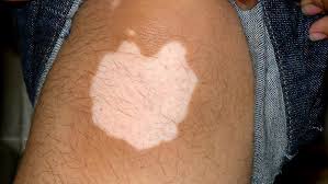 Vitiligo can also affect other parts of your body. All About Vitiligo Saikia Skin Care