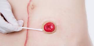 Whatever the cause, if you're looking to regain a more eve. Ostomy Care 101 Trivia Quiz Proprofs Quiz