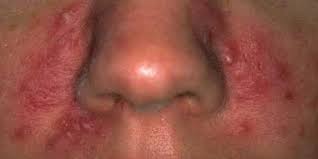 الذئبة_الحمراء يسرني ان اكون احد الداعمين لتثقيف مرضى #الذئبة_الحمراء في فعالية توعية بعد غد ان شاء الله ١٨ديسمبر٢٠١٩ الأربعاء الوقت ٨ص الى١ الظهر المكان. ÙØ§ ØªØ®Ø§ÙØ´ Ø§ÙØ°Ø¦Ø¨Ø© Ø§ÙØ­ÙØ±Ø§Ø¡ ÙØ´ Ù Ø¹Ø¯Ù Ø¨Ø³ Ø§ÙÙØ´Ù Ø§ÙÙÙÙÙ ÙØ³ÙØªØ© Ø§ÙØ¯ÙØ§Øº Ø£Ø®Ø·Ø± ÙØ¶Ø§Ø¹ÙØ§ØªÙ ØµÙØª Ø§ÙØ£ÙØ©