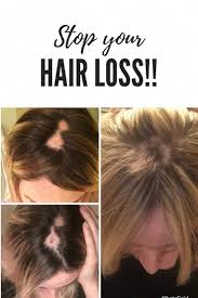Sometimes, it might go through balding. Stop Losing Hair Stoplosinghair Postpartum Hair Loss Lost Hair Hair Loss