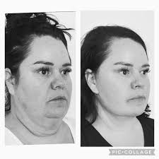 Snatched! This is one of my all time favorite patients. 45 y/o neck lift  face lift, 8weeks. Weight loss after age 35 creates extra skin everywhere,  we are seeing a ton of
