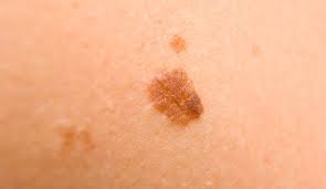 Are You Spot Aware Seborrheic Keratosis Castor Oil For Skin Skin Tag Removal