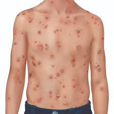 Image result for Varicella zoster on human skin