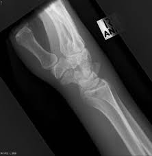 Triquetral Fracture Radiology Reference Article Radiopaedia Org The triquetral bone is located in the wrist on the medial side of the proximal row of the carpus between the lunate and pisiform bones. triquetral fracture radiology