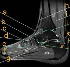 The foot contains many bones, muscles, tendons, and other structures. Mri Anatomy And Imaging Proprofs Quiz